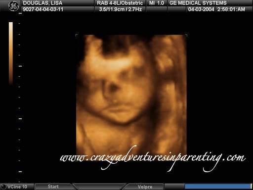 3D sonogram