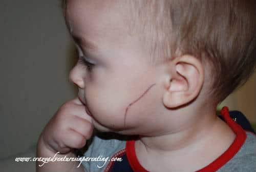 Infant pen drawing on face
