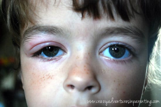 toddler's swollen eye