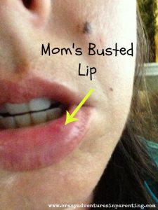 busted lip mom